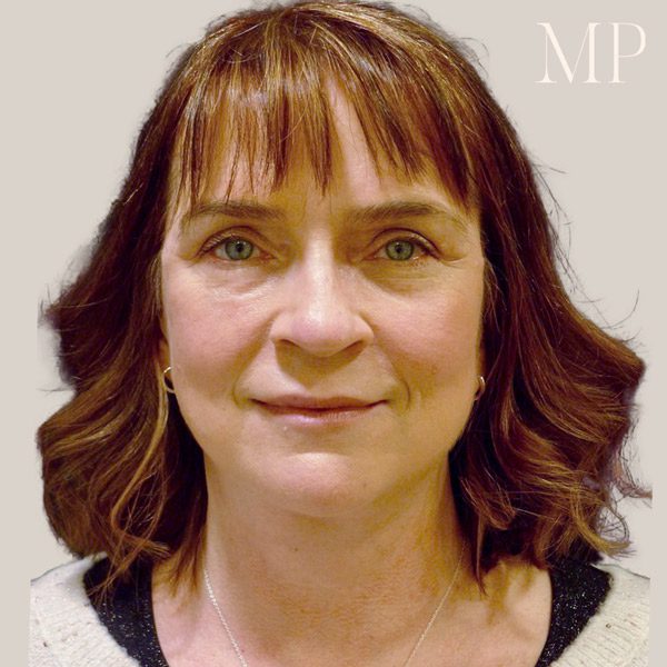 Facelift procedure overview