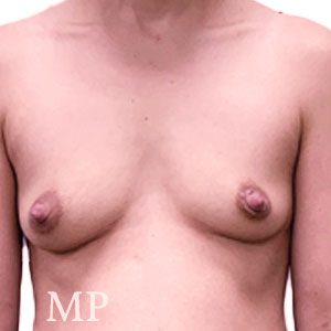 Before After Image
