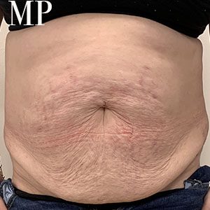 Before After Image