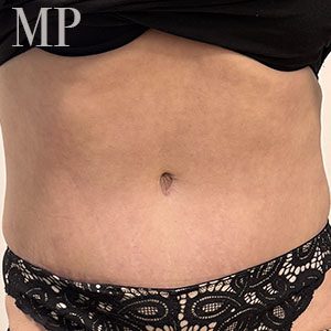 Before After Image