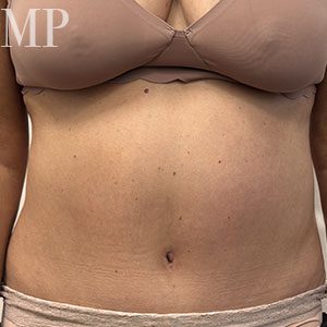 Before After Image