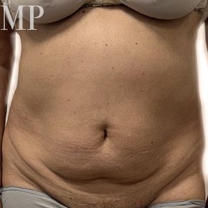 Before After Image
