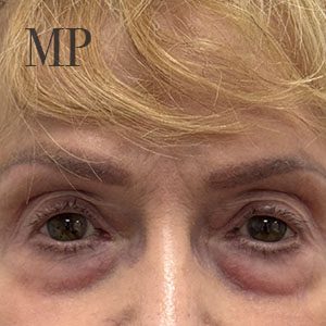 Before After Image
