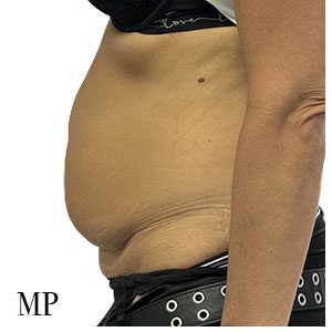 Before After Image