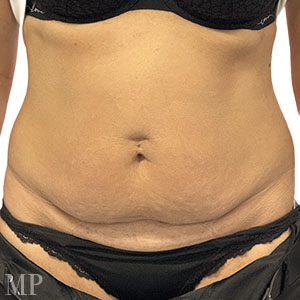 Before After Image