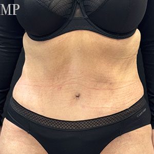Before After Image