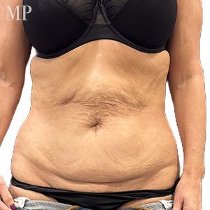 Before After Image