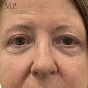 Before After Image