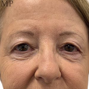 Before After Image