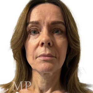 CM-pre-op-High-SMAS-deep-plane-face-lift-pre-op-