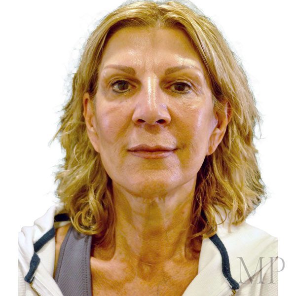 Face-Lift-2-After