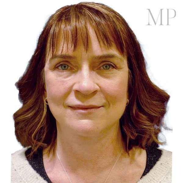 Face-Lift-5-From-Front-After
