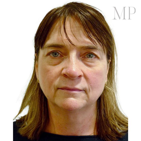 Face-Lift-5-From-Front-Before
