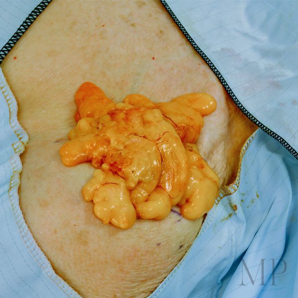 Intraoperative-Shoulder-Lipoma-Excision