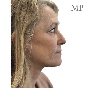 JF-post-op-right-lateral-high-smas-lipofilling-hall-marked-