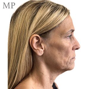 JF-pre-op-right-lateral-high-smas-lipofilling-hall-marked-