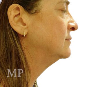 LS-face-lift-lateral-pre-op-copy