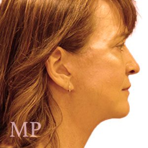 LS-lateral-post-face-lift-copy