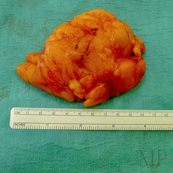 Lipoma-2-Peri-Operative