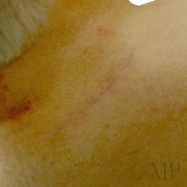 Lipoma-2-Post-Operative-Scar
