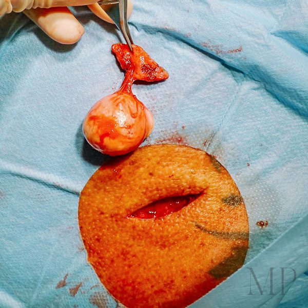 Matthew-Potter-Sebaceous-Cyst (1)