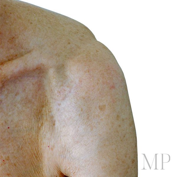 Post-Operative-Shoulder-Lipoma-Scarring