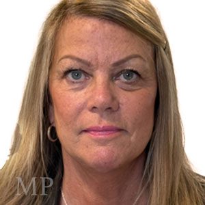 TH-post-op-face-lift-