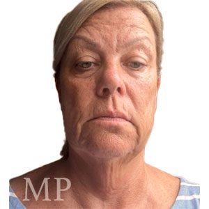 TH-pre-op-face-lift-