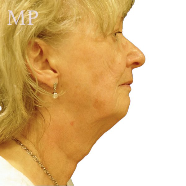 mm-lateral-profile