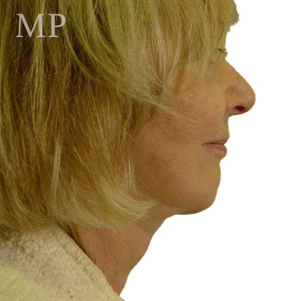 mm-post-op-lateral-