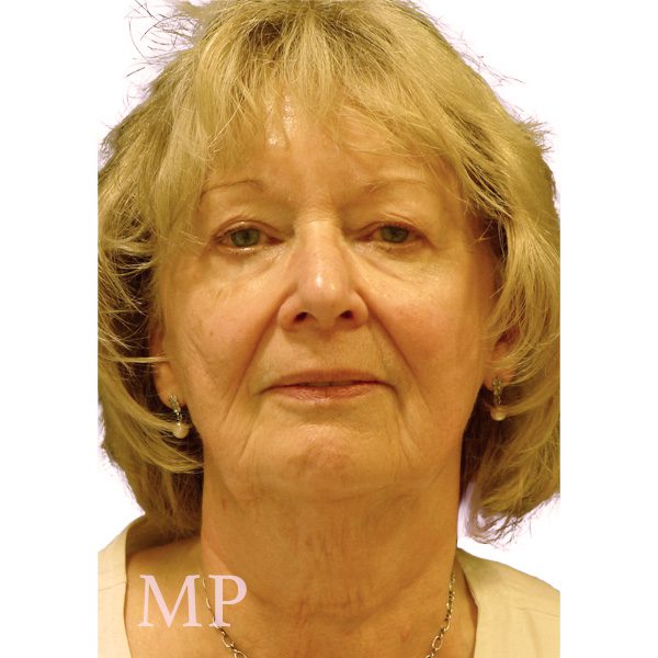 mm-pre-op-