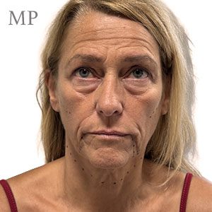 pre-op-face-lift-JF-aug-26-hall-marked-