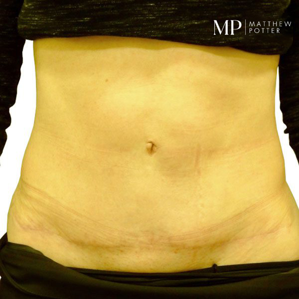 Abdominoplasty-3-Post-Op