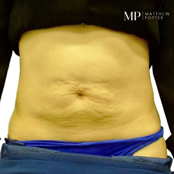 Abdominoplasty-3-Pre-Op