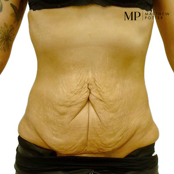 Abdominoplasty-4-Pre-Op