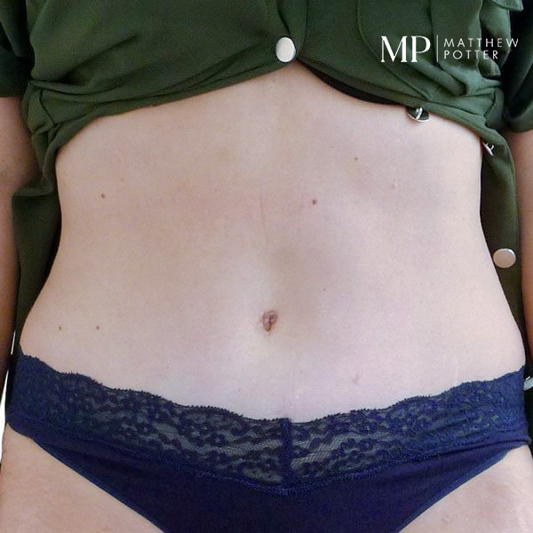 Abdominoplasty-Patient-03-After