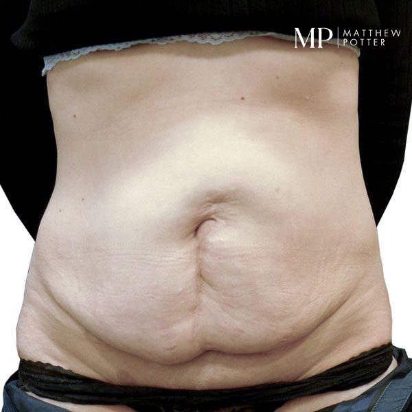 Abdominoplasty-Patient-03-Before