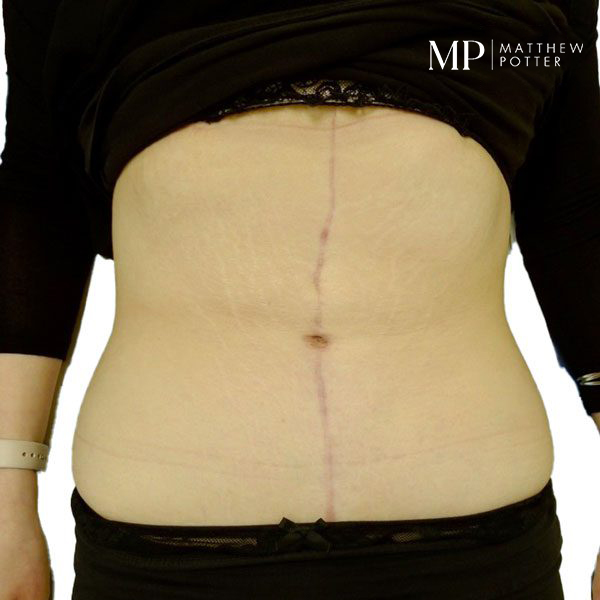 Abdominoplsty-2-Post-Op