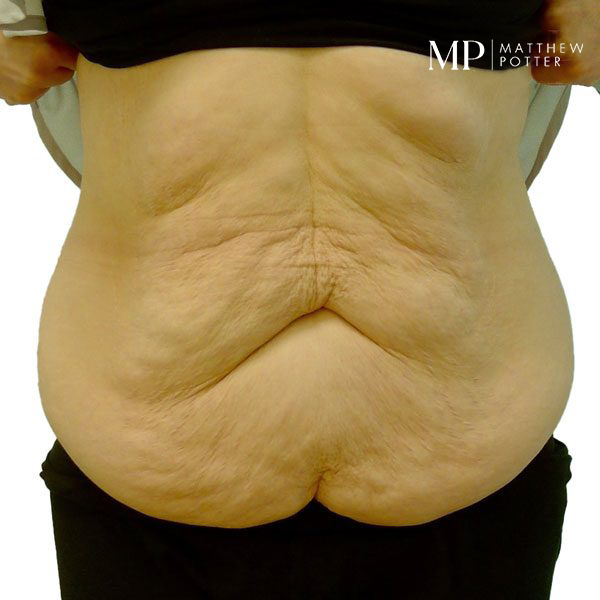 Abdominoplsty-2-Pre-Op