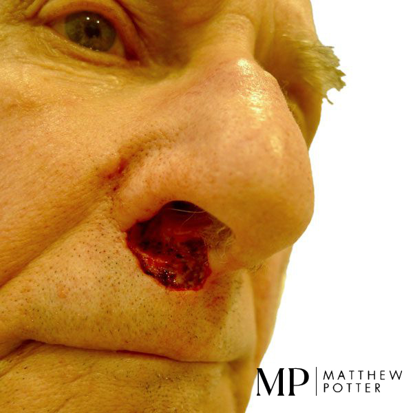Before-Reconstruction-Following-BCC-MOHS-Excision