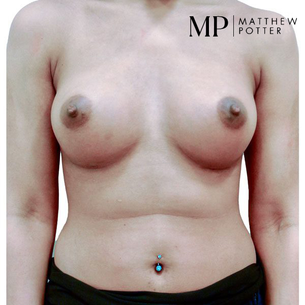 Breast-Aug-1-Post-Op