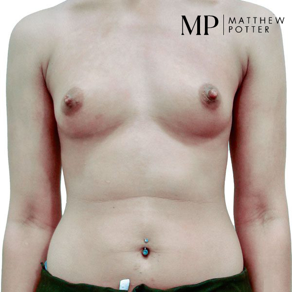 Breast-Aug-1-Pre-Op