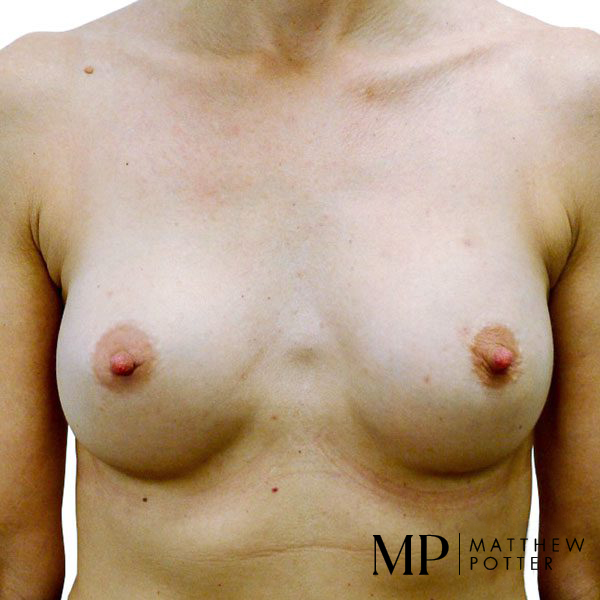 Breast-Aug-2-Post-Op