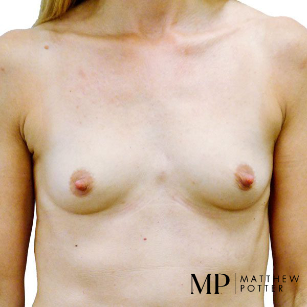 Breast-Aug-2-Pre-Op