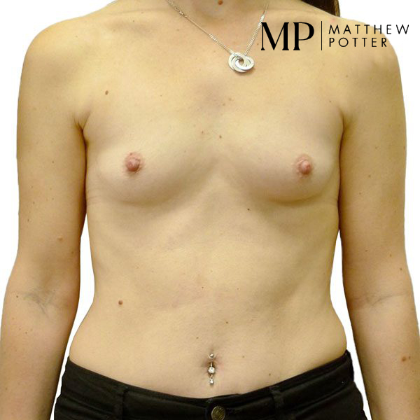 Breast-Aug-3-Pre-Op