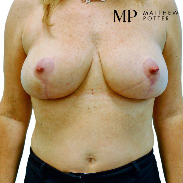 Breast-Reduction-1-Post-Op