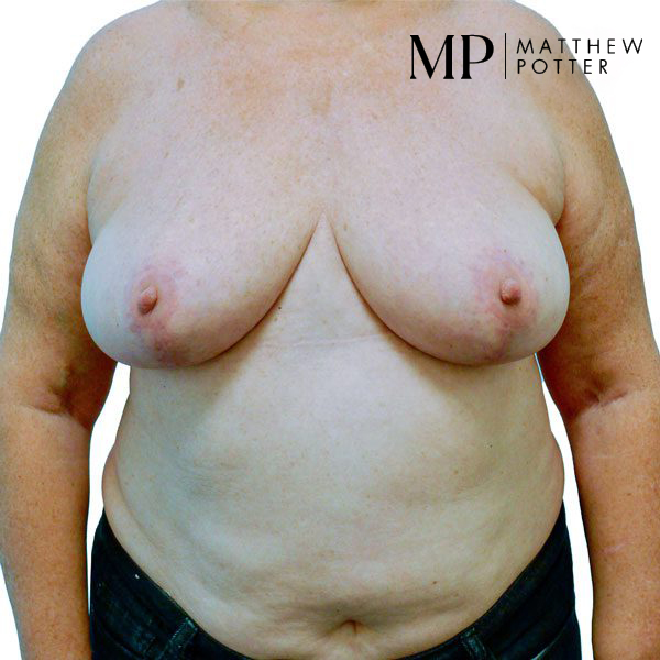Breast-Reduction-2-Post-Op