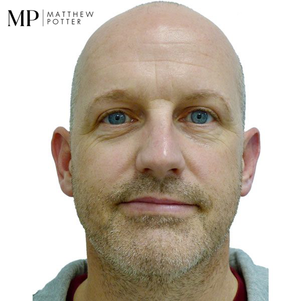 Direct-Brow-Lift-After-Male