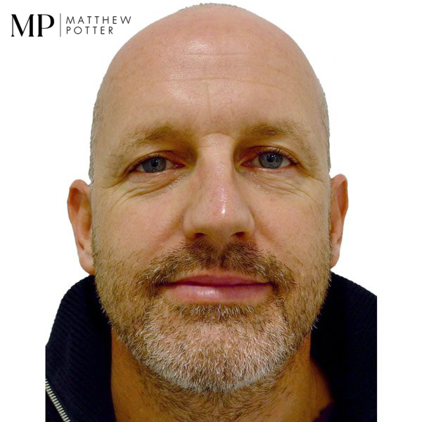 Direct-Brow-Lift-Before-Male