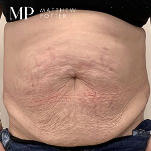 EM-pre-op-abdominoplasty.-jpg